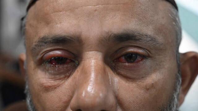 Un homme souffrant d'une infection oculaire attend d'être soigné dans un hôpital au Pakistan. Crédit photo: ARIF ALI / AFP