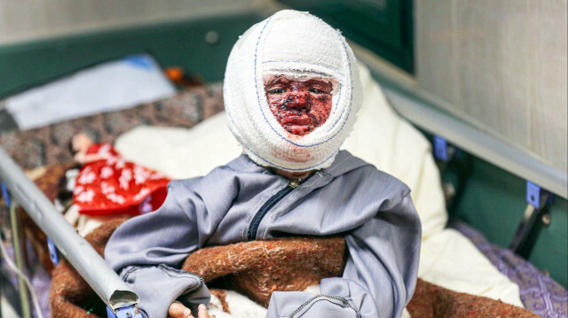 Yüzünde ve vücudunda derin yanıklar oluşan minik Seca, tedavi gördüğü Şifa Hastanesi'nde ikinci kez İsrail ordusunun saldırılarına maruz kaldı.