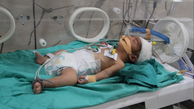 Un bébé Palestinien, hospitalisé pour cause de malnutrition et de déshydratation, à l'hôpital Kamal Adwan à Gaza, le 02 mars 2024.