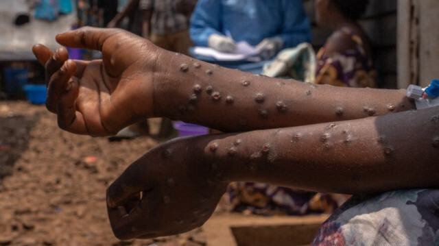 Un patient atteint de mpox est assis sur un banc à l'hôpital de Kavumu, à 30 km au nord de Bukavu, dans l'est de la République démocratique du Congo, le 24 août 2024.