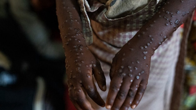 Un patient atteint d'une forme sévère de l'épidémie de variole est traité à l'hôpital de Kavumu, à 30 km au nord de Bukavu, dans l'est de la République démocratique du Congo, le 24 août 2024.