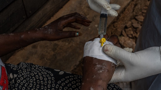 Un patient atteint de la variole reçoit une injection intraveineuse à l'hôpital de Kavumu, à 30 km au nord de Bukavu, dans l'est de la République démocratique du Congo, le 24 août 2024.