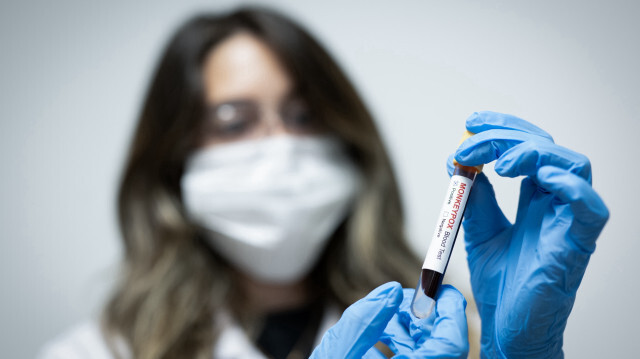 Une femme tient un tube de prélèvement sanguin marqué positif pour la variole du singe (Mpox) à Ankara, en Türkiye, le 28 août 2024.