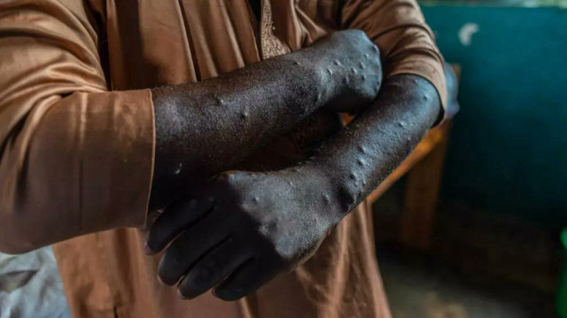 La République démocratique du Congo enregistre 20 décès liés au Mpox (variole simienne) au début de 2025, une situation jugée préoccupante par l'OMS.