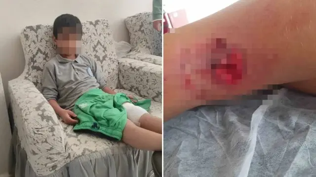 Köpeğin saldırdığı çocuk bacağından yaralandı