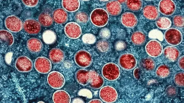 Les autorités sanitaires namibiennes ont annoncé un premier cas de mpox à Swakopmund et déclenché une réponse d’urgence pour contenir la propagation du virus.