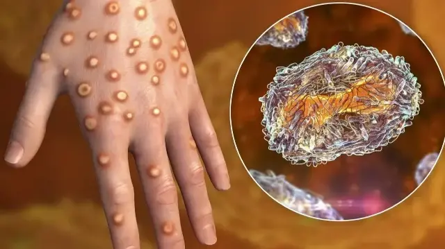 Un homme non vacciné et n’ayant pas voyagé à l’étranger a été infecté par une nouvelle souche du virus, également signalée en Espagne et aux États-Unis.