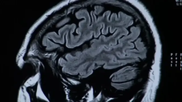 Poor sleep quality linked to accelerated brain aging in major study