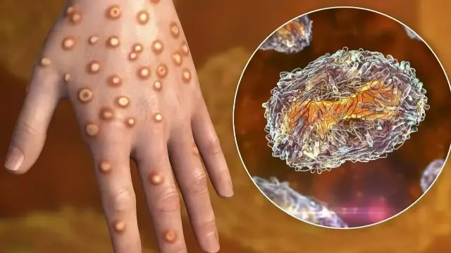 Un nouveau variant du virus, le clade Ib, s’étend désormais au-delà de l’Afrique, tandis que toutes les souches connues restent actives selon l’Organisation mondiale de la santé.