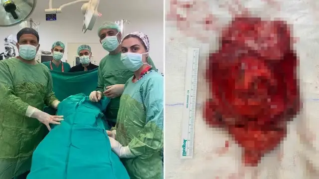 Tıpta ender rastlanan dev tümör ameliyatla çıkarıldı.