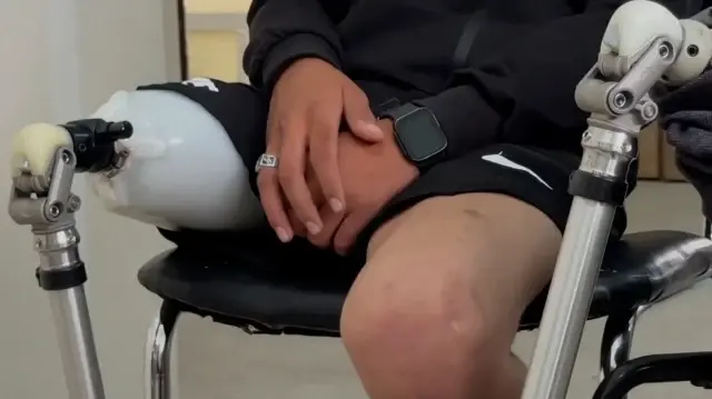 تأهيل مبتوري الإبادة بغزة بأطراف صناعية يعيد إليهم نصف الحياة