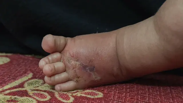 Le pied de Jannah Mutair présente des signes de lésions cutanées alors qu'elle se repose sur un lit au complexe médical Nasser à Khan Yunis, Gaza, le 8 novembre 2025.