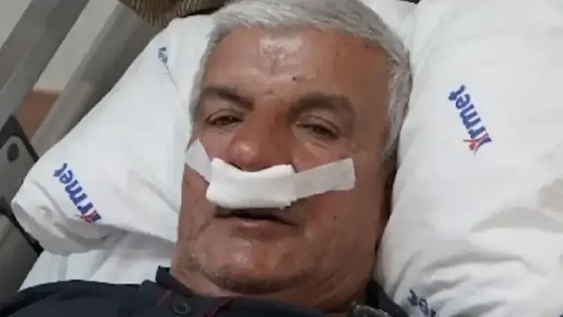 Yıllarca burnu tıkalı yaşadı: 65 yaşındaki adamın burnundan 100 gram taş çıktı