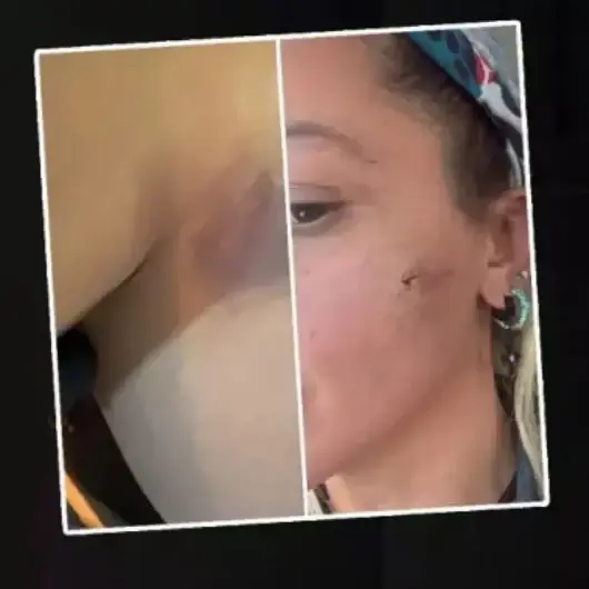 'Eşim şiddet uyguluyor!' deyip yüzündeki morlukları paylaştı: Ünlü oyuncunun yardım çığlığı sosyal medyayı salladı