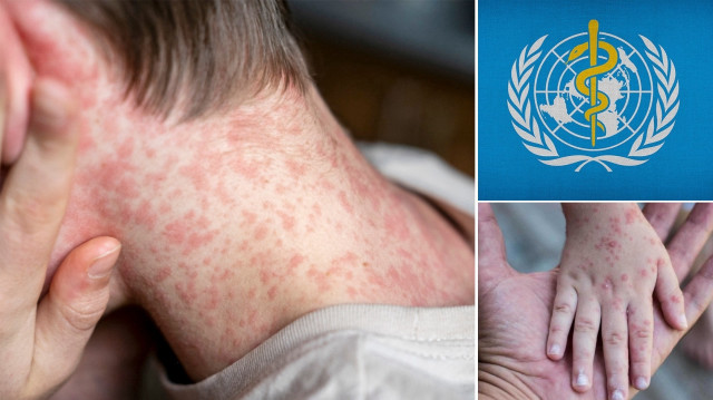 DSÖ'ye göre; Avrupa Bölgesi'nde 2024'te en yüksek kızamık vakaları görüldü.