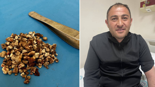 Doktorlar bile şaşkın: Hastanın iki böbreğinden 300'ün üzerinde taş çıktı