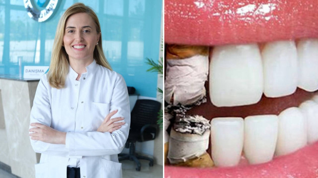 Biruni Üniversitesi Diş Hekimliği Fakültesi'nden Prof. Dr. Burcu Karaduman, sigara ve elektronik sigaranın ağız sağlığındaki olumsuz etkilerine dikkat çekerek tütün ürünlerinin tamamı ağız ve diş sağlığında yıkıcı etkiye sahip olduğunu belirtti.