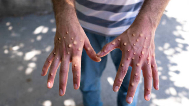 Gana Sağlık Servisi (GHS), ülkenin 10 vilayetinde 34 yeni M-çiçeği (mpox) vakasının tespit edildiğini duyurdu ve toplam vaka sayısının 79’a ulaştığını bildirdi.