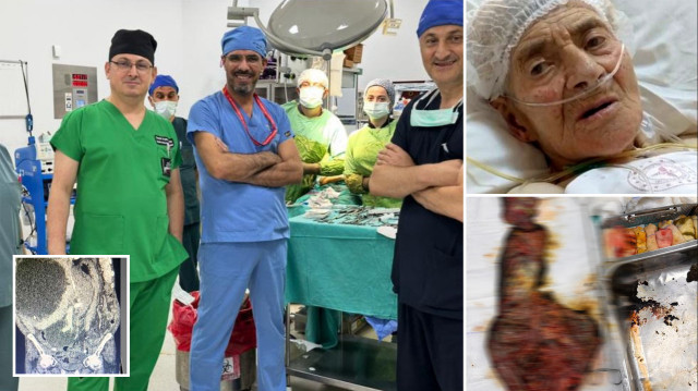 Doktorlar bile inanamadı: Hastanın karaciğerinden 90 santimetrelik kedi-köpek kisti çıkarıldı