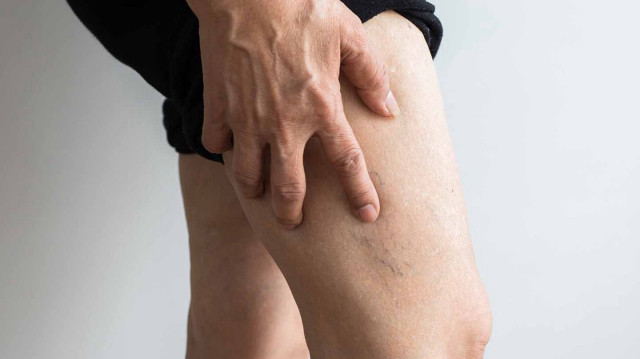 Yaz aylarında artan varis şikayetleri ihmal edilmemeli