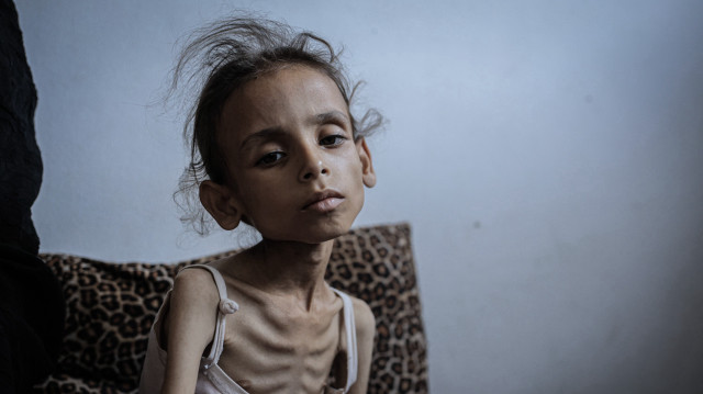 Meryem Abdulaziz Mahmud Dawwas, une fillette de 9 ans réfugiée avec sa famille dans un centre d’hébergement du centre-ville de Gaza pesant 10 kilos, le 1er aout 2025.