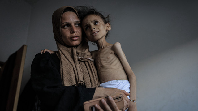 غزہ میں غذائی قلت کا شکار ایک بچی