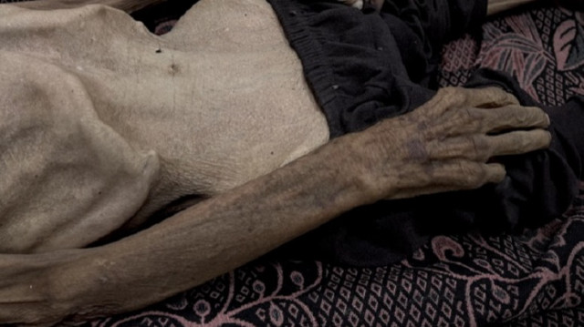 مجوعون منهكون.. أطباء بغزة يعيشون على محاليل لإنقاذ المصابين 
