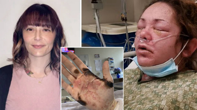 Üç çocuk annesi bir kadın, kullandığı ağrı kesiciye bağlı nadir görülen bir reaksiyon sonucu cildinin 'çarşaf gibi dökülmesine' neden olan yaşadığı korkunç deneyimi anlattı.