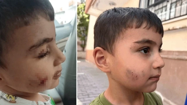 Uyurken dehşeti yaşadı: Lağım faresi ısıran çocuğa kuduz aşısı yapıldı