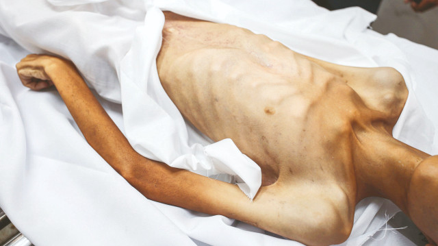 17 yaşındaki Atıf Ebu Hatır, son nefesini verdiğinde 25 kiloydu.

