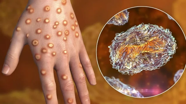 Les autorités sanitaires ghanéennes alertent sur une progression soutenue du virus mpox malgré une campagne de vaccination en cours.