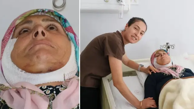 15 yıldır yüz felci olan kadın ameliyatla sağlığına kavuştu