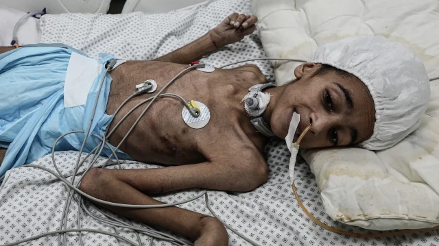 11-year-old Palestinian Ihab Mu’men Washah, who was left paralyzed after being injured, fgiht for his life in the intensive care unit of Al-Aqsa Martyrs Hospital in Deir al-Balah, Gaza on September 08, 2025. Ihab also faces acute malnutrition due to the Israeli blockade, which has cut off access to medicine and nutritious food. (AA)