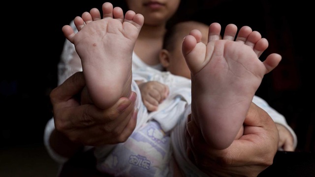 Hong Hong bebek binde bir rastlanan polidaktilizm ile dünyaya geldi. 