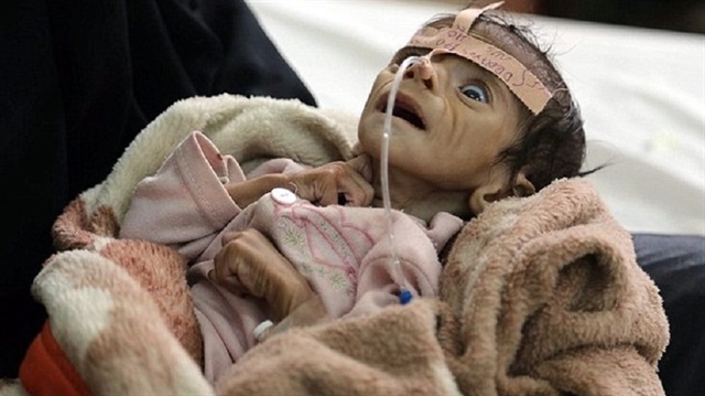 Yemenli Uday bebek açlıktan ölen masumlardan sadece birisi. 