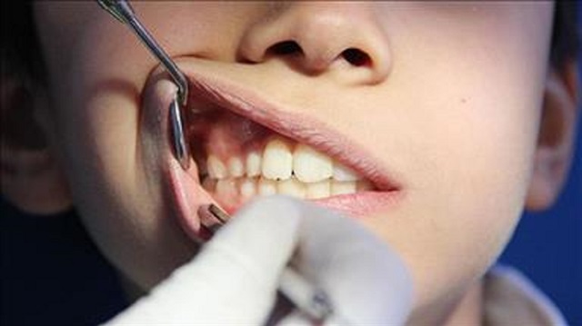 Uzmanlar diş temizliğine Ramazan ayında açlıkla beraber daha da dikkat edilmesi gerekiyor.