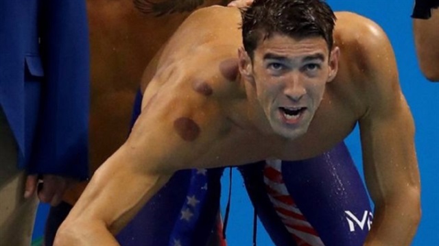 Yaz Olimpiyat Oyunları'nın en çok madalya kazanan sporcusu ABD'li yüzücü Michael Phelps'in sırtındaki lekeler, hacamat yöntemiyle yarışlara hazırlandığını gösteriyor.