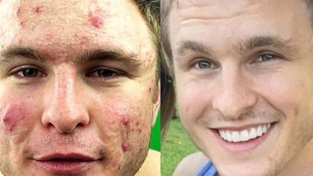 Vücut geliştirmeci Brian Turner, ergenliğinden beri hayatını mahveden akne probleminden veganlıkla kurtuldu. Daily Mail'in haberine göre, 23 yaşındaki Brian deneyebileceği her yolu denedikten sonra çözümü vegan diyetinde buldu.