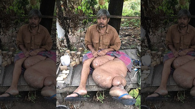 Fil hastalığına yakalanan Taylandlı adam, en ufak bir hareketinde bacakları ağrıdığı için çalışamıyor. 