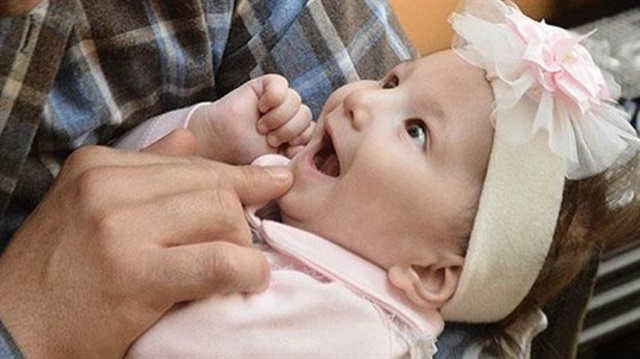 Zeynep bebekte görülen sendrom dünyada sadece 50 bin kişide var. 