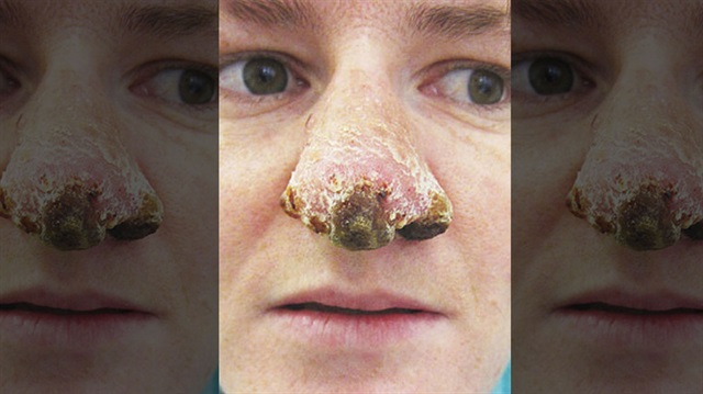 İki tane organizma genç kadının burnunun çürümesine neden oldu.