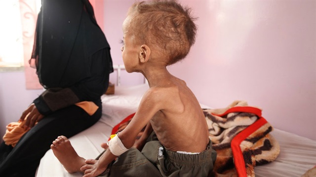 Yemen'de  462.000 çocuk ciddi oran da kötü beslemeden dolayı şiddetli hastalıklarla boğuşuyor. 