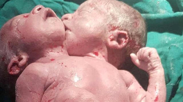 Bebeğin yapışık ikiz değil kesinlikle tek bir bebek olduğu ancak iki adet kafası olduğu doktorlarca açıklandı. 