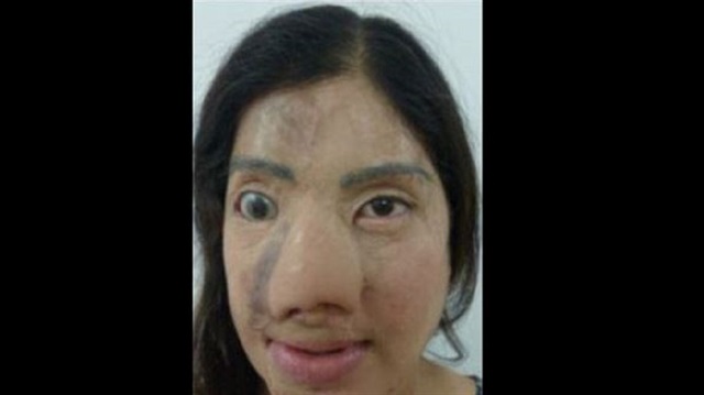  Uçak hostesi olmak isteyen genç kadının yüzünü arkadaşı sülfirik asitle yaktı. 