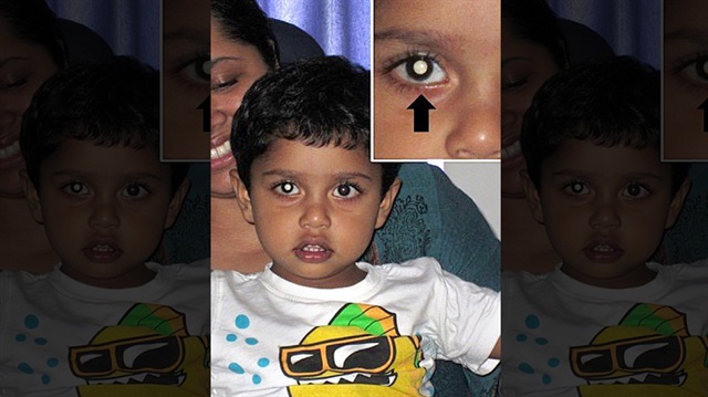2 yaşındaki çocuğun gözündeki sinirlerde tümör olduğu ortaya çıktı.