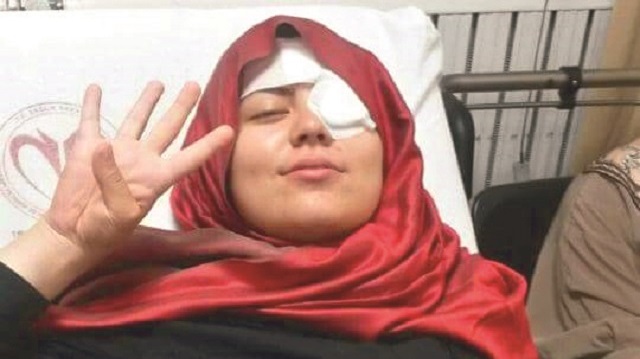 Sodalı saldırı nedeniyle gözlerine dolan cam parçaları özel bir yöntemle toplanan Dilara Sina Tabak, aylarca tedavi görmüştü.