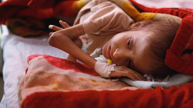 Dünyanın en büyük açlık krizlerinden birinin yaşandığı Yemen'de milyonlarca çocuk açlıktan ölmek üzere. 
