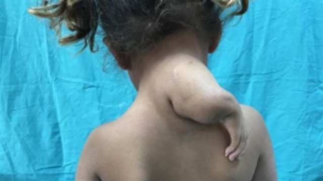 4 yaşındaki Hülya yapılan operasyonla sağlığına kavuştu
