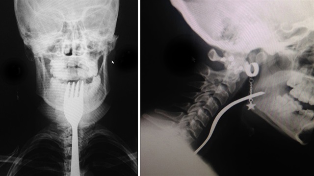 Genç kızın boğazına takılan çatal röntgenle böyle görüntülendi. 
