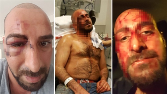 Irkçı grubu tarafından saldırıya uğrayan Ali Fakıoğlu 